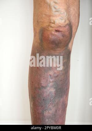 Schwere Blutergüsse am rechten Bein der Frau mit tiefen lila Blutergüssen vom Knie bis zum Fuß UK Stockfoto