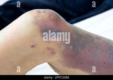 Schwere Blutergüsse am rechten Bein einer Frau nach einem Sturz mit tiefen lila Blutergüssen vom Knie bis zum Fuß UK Stockfoto