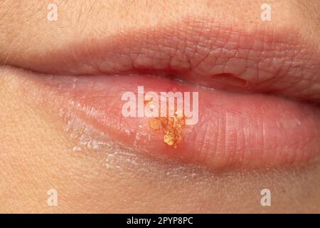 Makro von Lippen der Frau mit Lippenherpes. Herpes-simplex-Pusteln-Nahaufnahme bei einer weiblichen Mundhöhle. Stockfoto