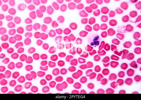 Menschlicher Blutausstrich unter dem Mikroskop, Lichtmikroskop mit roten Blutkörperchen und Neutrophilen Stockfoto