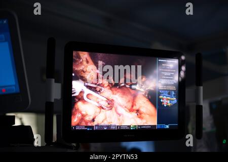 Moderne Hybridchirurgie, innovative 3D-Technologie mit dem DaVinci-System eine robotergestützte Chirurgie-KI-Robotik. Operation eines Tumors an Leber und Magen am Universitätsklinikum Carl Gustav Carus, Klinik und Poliklinik für Viszeralchirurgie, Thoraxchirurgie und Gefässchirurgie und Zentrum für Tumorerkrankungen in Dresden. Roboterassistierte Chirurgie ist ein modernes chirurgisches Verfahren in der Medizin. Es ermöglicht dem Chirurgen die Durchführung minimal invasiver chirurgischer Techniken mit Unterstützung des robotergestützten Systems Stockfoto