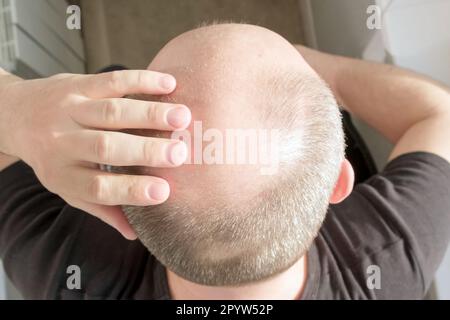 Glatze, Mann besorgt wegen Haarausfall. Männlicher Kopf mit Glatze. Bekämpfung des Haarverlustes bei Männern Stockfoto