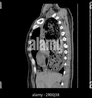 Achalasie der Speiseröhre, CT-Scan Stockfoto