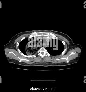 Achalasie der Speiseröhre, CT-Scan Stockfoto