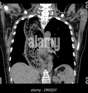 Achalasie der Speiseröhre, CT-Scan Stockfoto