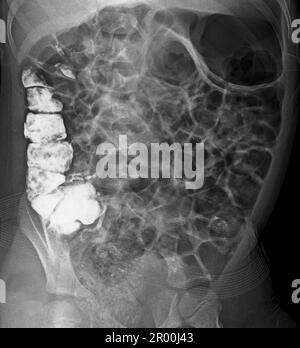 Die normale Appendikographie Stockfoto