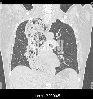 Achalasia of the oesophagus, CT scan Stock Photo