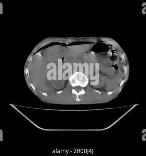 Pneumoperitoneum, CT-Scan Stockfoto