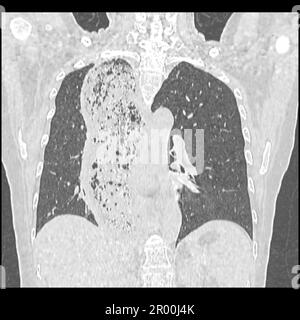 Achalasie der Speiseröhre, CT-Scan Stockfoto