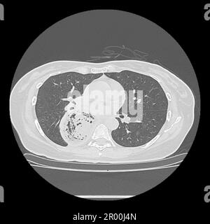 Achalasie der Speiseröhre, CT-Scan Stockfoto