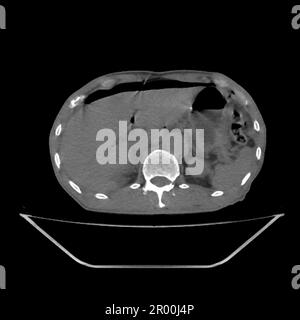 Pneumoperitoneum, CT-Scan Stockfoto