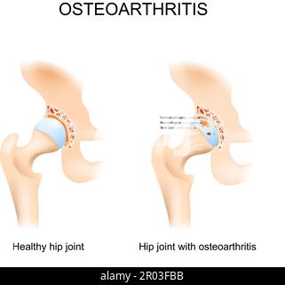 Hüftgelenk mit Osteoarthritis mit Hüftkopf und Hüftpfanne des Beckens. Ein Vergleich zwischen einem gesunden Hüftgelenk und einem mit Arthrose Stock Vektor