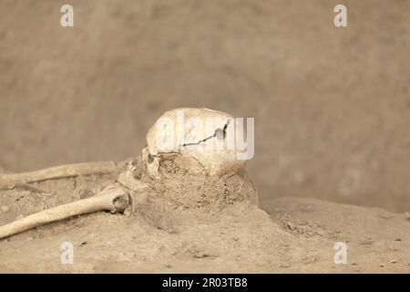 Römisches Skelett mit trepaniertem chirurgischen Eingriff-Schädelgrat Stockfoto