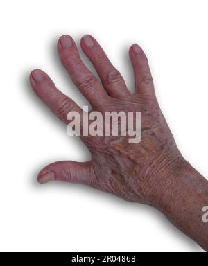 Hand einer älteren Frau mit Arthrose. Degenerative Gelenkerkrankungen. Weißer Hintergrund, Draufsicht Stockfoto