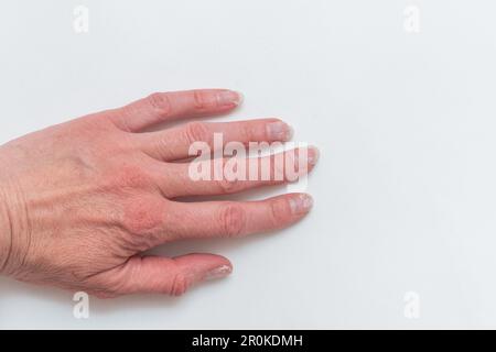 Nahaufnahme einer uralten Frauenhand mit Falten mit natürlichen Nägeln, überwucherter Kutikula auf weißem Hintergrund. Schiefe Finger, Gicht. Eine Hand mit Age-R Stockfoto