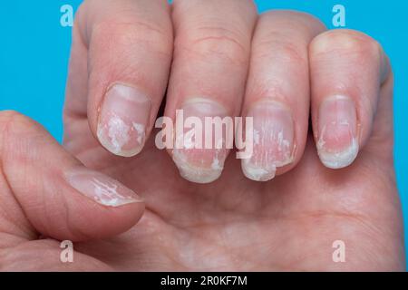 Schuppige gebissene und brüchige Nägel ohne Maniküre. Nachwachsende Nagelkutikula und beschädigte Nagelplatte nach Gelpolitur auf blauem Hintergrund. Stockfoto