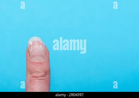 Ein weiblicher Finger mit gebissenen und gebrochenen Nägeln ohne Maniküre mit einer übergewachsenen Kutikula und einer beschädigten Nagelplatte nach dem Auftragen von Gelpolitur. Kosmetisch Stockfoto