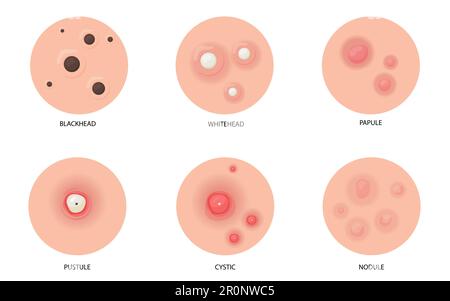 Verschiedene Arten von Akne-Flachbildungs-Set für das Webdesign Stock Vektor