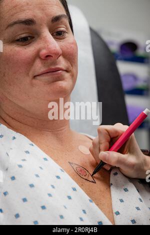 Der Dermatologe konsultiert den Patienten nach der Zeichnung auf der Brust einer jungen 30s-Frau für die Exzision des Basalzellkarzinoms. Stockfoto