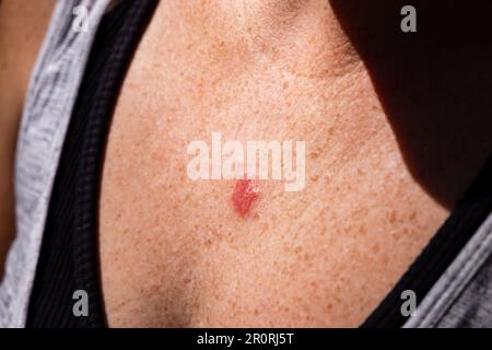 Junge Frau 30s Nahaufnahme der Brust vor Anwendung von Imiquimod-Creme-Medikation beim Basalzellkarzinom. Stockfoto