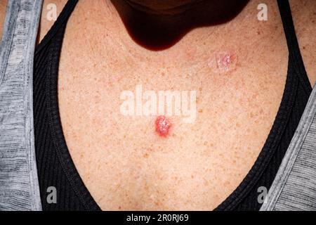 Junge Frau 30s Nahaufnahme der Brust vor Anwendung von Imiquimod-Creme-Medikation beim Basalzellkarzinom. Stockfoto