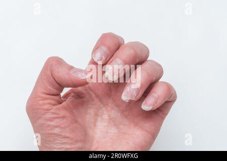 Gebissene und gebrochene Nägel ohne Maniküre mit einer übergewachsenen Nagelhaut und einer beschädigten Nagelplatte nach Auftragen von Gelpolitur. Die Handfläche einer Frau. Weil Stockfoto