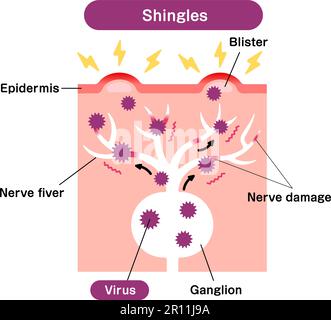 Vektordarstellung zum Mechanismus der Gürtelrose ( Herpes zoster ) Stock Vektor