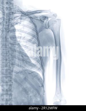 Röntgenaufnahme des linken Humerusknochens zur Diagnostik der Humerusfraktur. Stockfoto