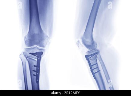 Röntgenbild des rechten Knies AP und laterale Ansicht zeigt die totale Knieartroplastik und Frakturen des Tibiaplateaus mit Platten- und Schraubfixierung. Stockfoto