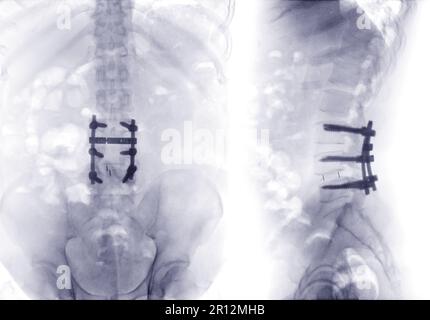 Röntgenbild der Lendenwirbelsäule oder der Lendenwirbelsäule AP und laterale Ansicht post operative fixierte Lendenwirbelplatten und Schraube. Stockfoto