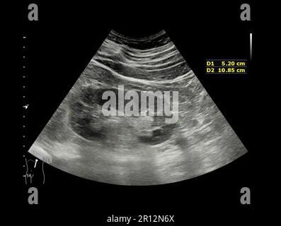 Ultraschall der Niere oder KUB zum Screening von Nierensteinerkrankungen oder Urolithiasis. Stockfoto