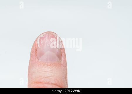 Ein weiblicher Finger mit gebissenen und gebrochenen Nägeln ohne Maniküre mit einer übergewachsenen Kutikula und einer beschädigten Nagelplatte nach dem Auftragen von Gelpolitur. Kosmetisch Stockfoto