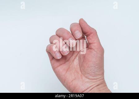 Gebissene und gebrochene Nägel ohne Maniküre mit einer übergewachsenen Nagelhaut und einer beschädigten Nagelplatte nach Auftragen von Gelpolitur. Die Handfläche einer Frau. Weil Stockfoto