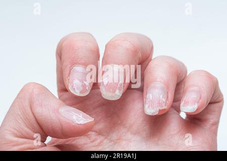 Schuppige gebissene und brüchige Nägel ohne Maniküre. Nachwachsende Nagelkutikula und beschädigte Nagelplatte nach Gelpolitur. Stockfoto