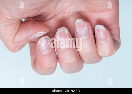 Schuppige gebissene und brüchige Nägel ohne Maniküre. Nachwachsende Nagelkutikula und beschädigte Nagelplatte nach Gelpolitur. Stockfoto