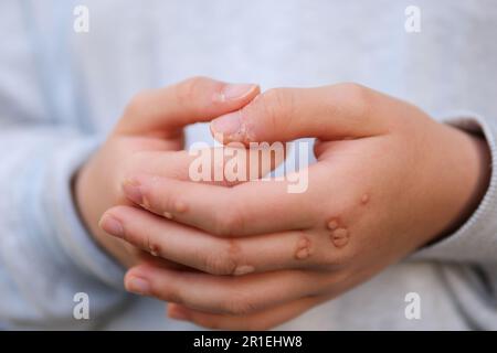 Hand mit Warze Mann Haut Nahaufnahme Hände von jungen Teenager Mädchen sind mit Warzen übersät eine Menge Papillome Virusinfektion auf Händen Berührung Kratzer betrachten nahe Nagel Virusinfektion Wucherungen an Fingern Stockfoto