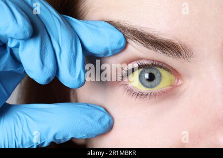 Arzt prüft Frau mit gelben Augen, Nahaufnahme. Symptom der Hepatitis Stockfoto