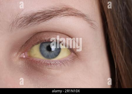 Frau mit gelben Augen, Nahaufnahme. Symptom der Hepatitis Stockfoto