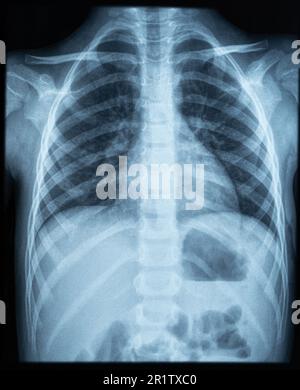 Röntgenbild des Thoraxbereichs eines jungen Kindes. Röntgen-Lungen-Röntgenbild Stockfoto