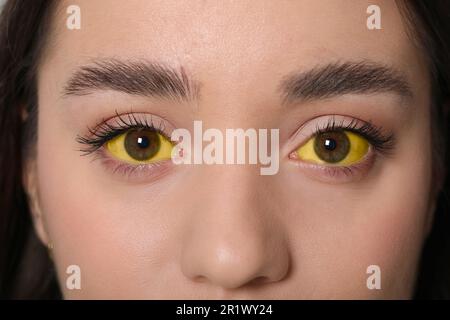 Frau mit gelben Augen, Nahaufnahme. Symptom der Hepatitis Stockfoto