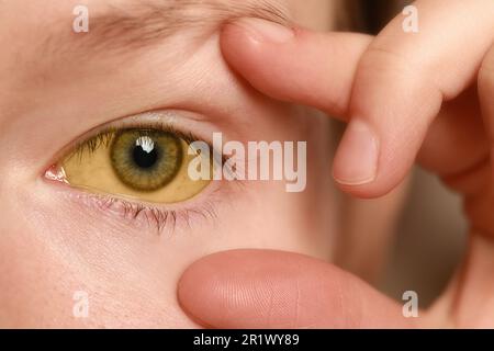 Frau mit gelben Augen, Nahaufnahme. Symptom der Hepatitis Stockfoto