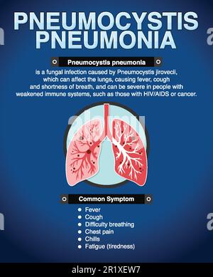 Informationsposter zur Illustration der Pneumocystis-Pneumonie Stock Vektor