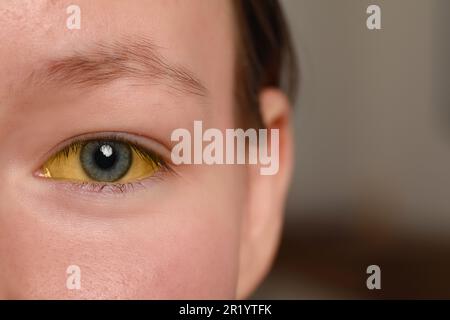 Frau mit gelben Augen auf verschwommenem Hintergrund, Nahaufnahme. Symptom der Hepatitis Stockfoto