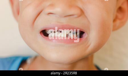 Ein kleiner Junge lächelt mit einem Zahn, Zahnfleischnaht Karies ausgedehnte frühe Karies, Zahnärzte mit schwarz-weiß Stockfoto