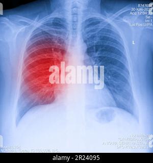 Röntgenbild der menschlichen Brust für eine medizinische Diagnose, zeigt Schmerzbereich rot. Thoraxröntgenaufnahme für Lungenuntersuchung, PA rechts oben Stockfoto