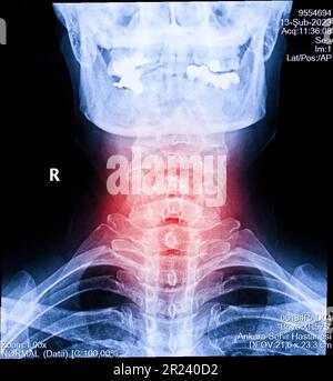 Röntgen von Hals und Halswirbelsäule. Bild einer Radiographie von Patienten mit Nackenschmerzen, Nervenwurzelkompression, Taubheitsgefühl am Handgelenk oder an der Flosse des Arms Stockfoto