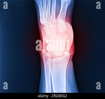 Arthritis im Sprunggelenk (Gicht, rheumatoide Arthritis) Stockfoto