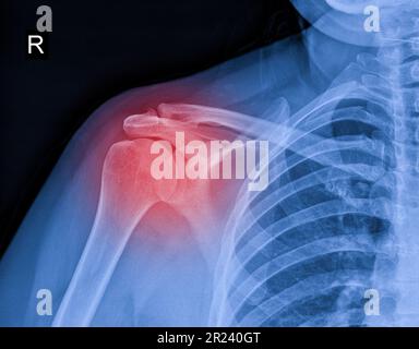 Röntgenbild von Schulterschmerzen, Schulterbandtendinitis, Schultermuskelbelastung Stockfoto