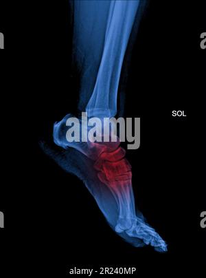 Fuss- und Sprunggelenkschmerzen im Röntgenbild, isoliert auf schwarzem Hintergrund Stockfoto