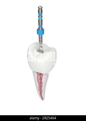 3D-Darstellung von Prämolarenzähnen mit endodontischer Drehfeile auf weißem Hintergrund. Endodontisches Behandlungskonzept. Stockfoto